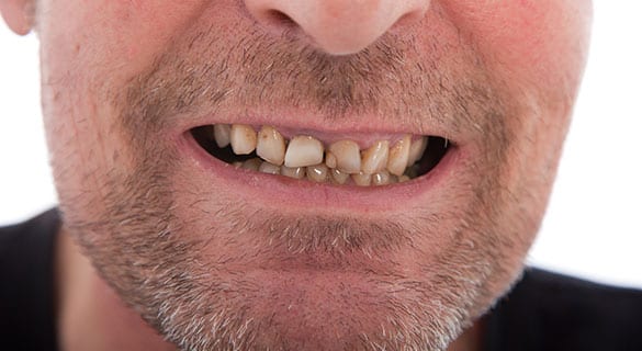 Gum-Disease-Dental-Treatment-Endeavour-Hills-Dentist-Sunrise-Dental-Surgery